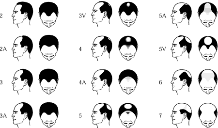 hair loss grading norwood chart