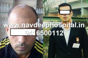 Before and After 7 months of FUE hair transplant of sports coach of India at Navdeep hospital and hair transplant Clinic, Panipat, Haryana, India.