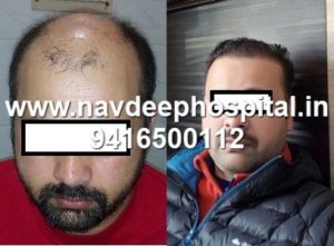 Before After FUE hair transplant at Navdeep hair hospital and laser center, Panipat, Haryana, India