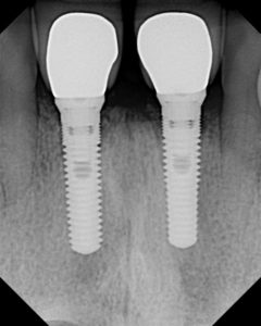 Dental implant by Dr Marrilin Gupta at Navdeep Hospital, Panipat, haryana, India