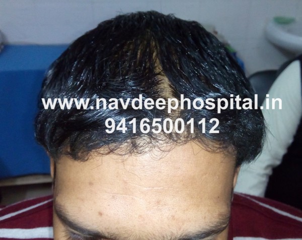 Result 5 months after FUE hair transplant at navdeep hospital and hair transplant center, Panipat, Haryana, India.