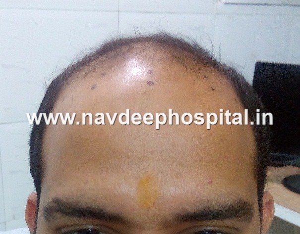Before hair transplant, Navdeep hair transplant center, Panipat, Haryana, India.