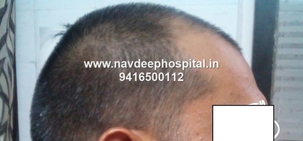 Before FUE hair transplant at navdeep hospital and hair transplant center, Panipat, Haryana, India.