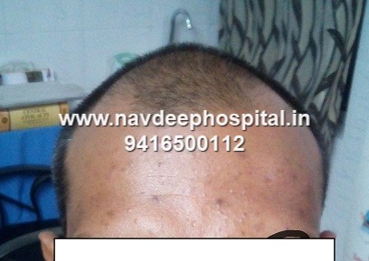 Before FUE hair transplant at navdeep hospital and hair transplant center, Panipat, Haryana, India.