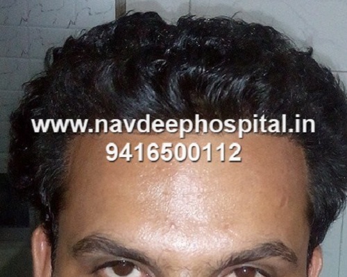 6 months after FUE hair transplant at Navdeep hospital and hair transplant center, Panipat, Haryana, India.