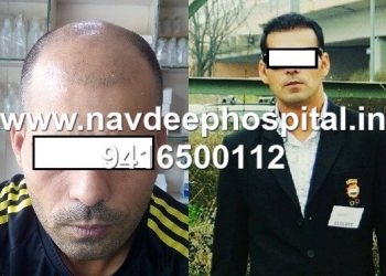 Before and After 7 months of FUE hair transplant of sports coach of India at Navdeep hospital and hair transplant Clinic, Panipat, Haryana, India.