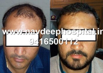 Before & After 6 months of FUE hair transplant at Navdeep hospital and hair transplant, Panipat, haryana, India.