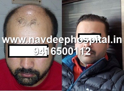 Before After FUE hair transplant at Navdeep hair hospital and laser center, Panipat, Haryana, India