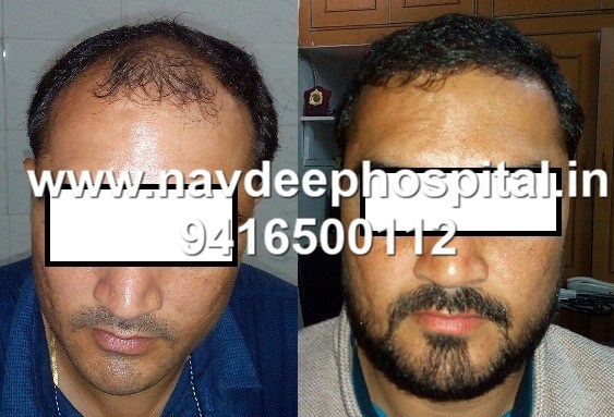 Before & After 6 months of FUE hair transplant at Navdeep hospital and hair transplant, Panipat, haryana, India.