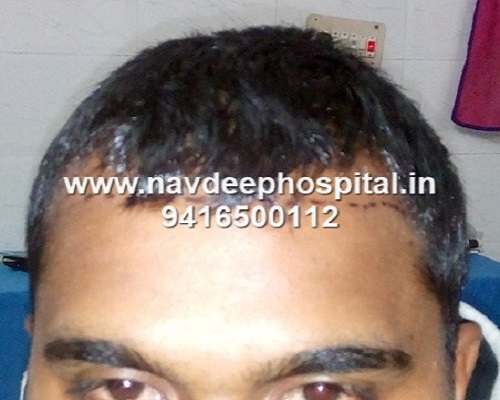 Before and after images. Before FUE hair transplant done 5 months back at Navdeep hair transplant and Laser center, Panipat, Haryana, India.