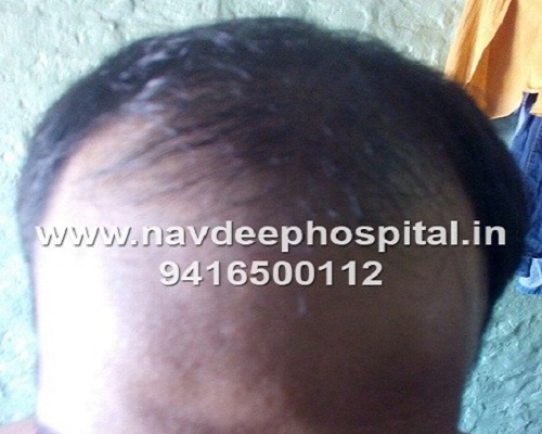 Before FUE hair transplant at Navdeep hair transplant and Laser center, Panipat, Haryana, India.