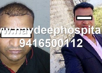 FUE Hair transplant result at 6 months at Navdeep hosptial and hair transplant, Panipat, haryana, India. Cheap and best