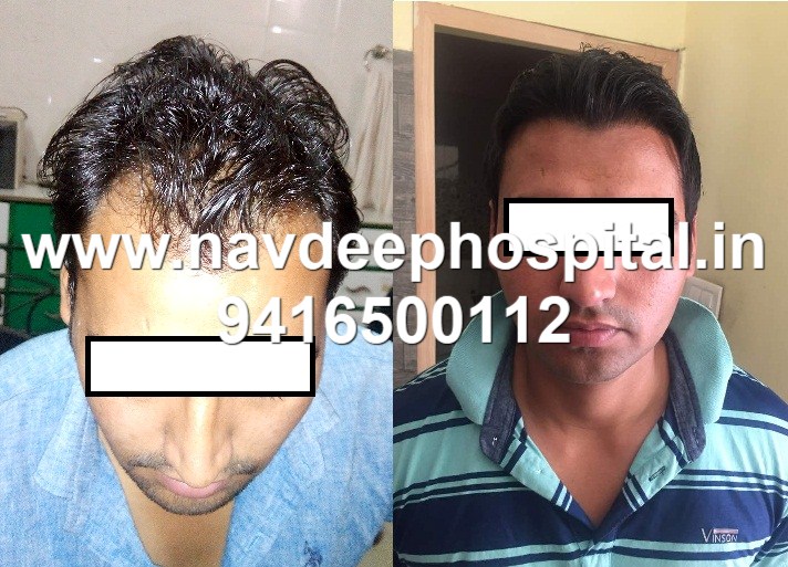 Before after of FUE hair transplant of Shimla, himachal pradesh. At Navdeep hospital and hair transplant, Panipat, Haryana, India.