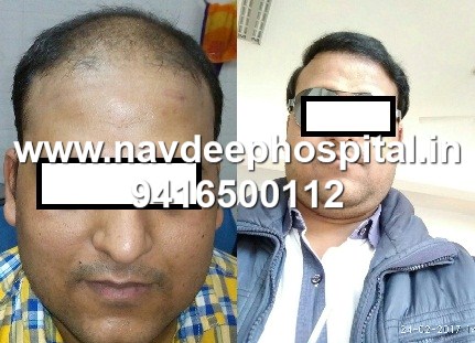 Before after result of FUE hair transplant at Navdeep hair hospital and laser center, Panipat, Haryana, India