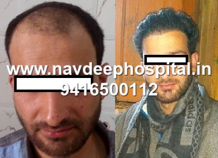 Before after of FUE hair transplant of Srinagar guy at Navdeep hospital and hair transplant, Panipat, haryana, India