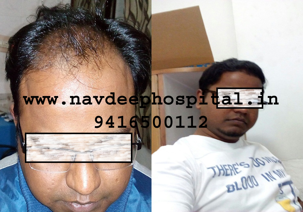 Before and 6 months after FUE hair transplant, Navdeep hospital, Panipat