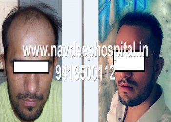 Before and 6 months after fue hair transplant at Navdeep hospital, Panipat, haryana, India