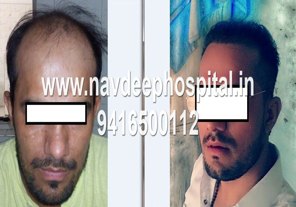 Before and 6 months after fue hair transplant at Navdeep hospital, Panipat, haryana, India