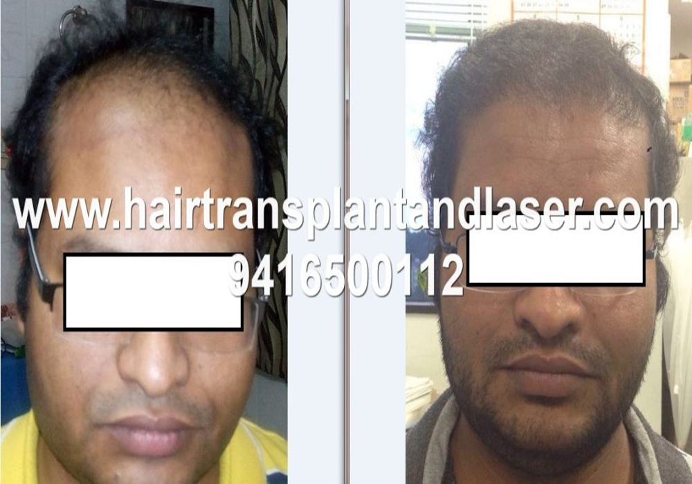Before and after photos of FUE hair transplant