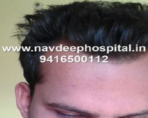 Before FUE hair transplant at Navdeep hospital and hair transplant center, Panipat, Haryana, India.