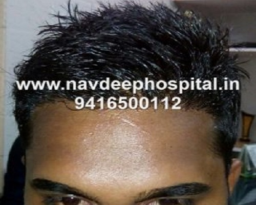 5 months after FUE hair transplant at Navdeep hair transplant and Laser center, Panipat, Haryana, India.