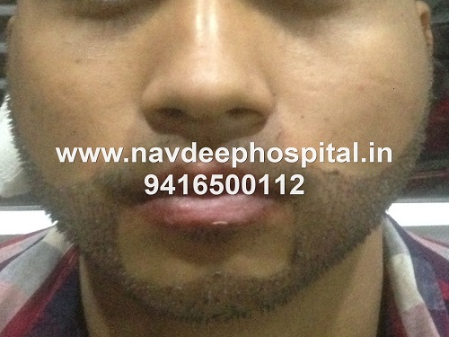 Immediately after FUE hair transplant for beard at Navdeep hair hospital and laser center, Panipat, Haryana, India