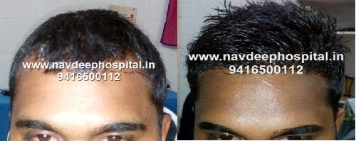 Best before after images of fue hair transplant in India at Navdeep hospital and hair transplant, Panipat, haryana.