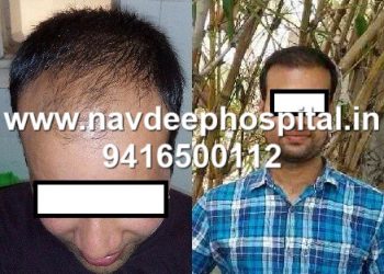 before after results of best hair transplant at Navdeep hospital and hair transplant, Panipat, Haryana, India.